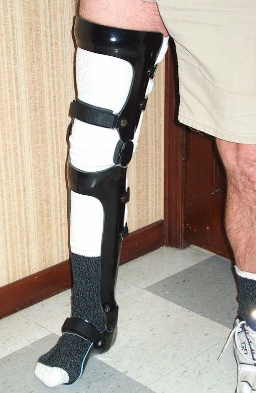 3D printed leg brace