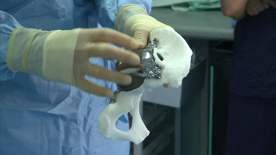 3D printed implants